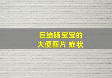 巨结肠宝宝的大便图片 症状